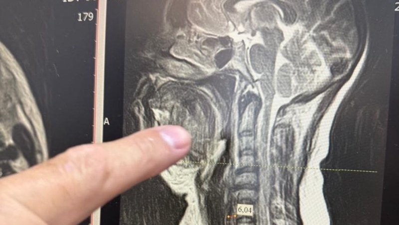 Врачи Ессентуков спасли женщину с опасным осложнением после разрушения зуба