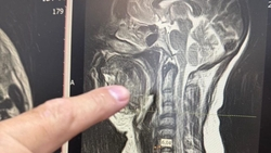 Врачи Ессентуков спасли женщину с опасным осложнением после разрушения зуба